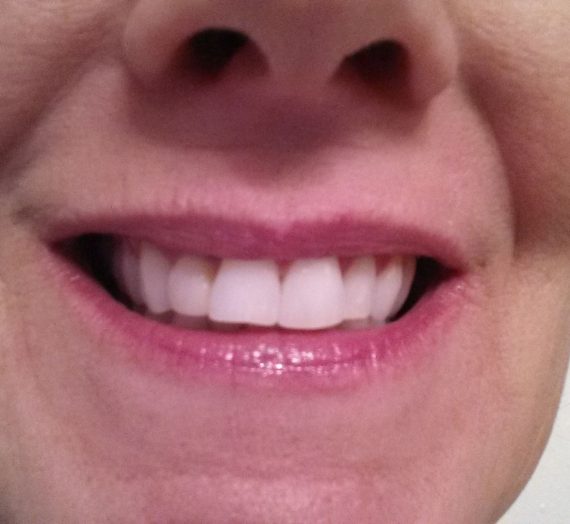 Luster Premium White Pro Light Teeth Whitening System
